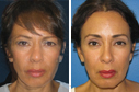 Before & After Photos